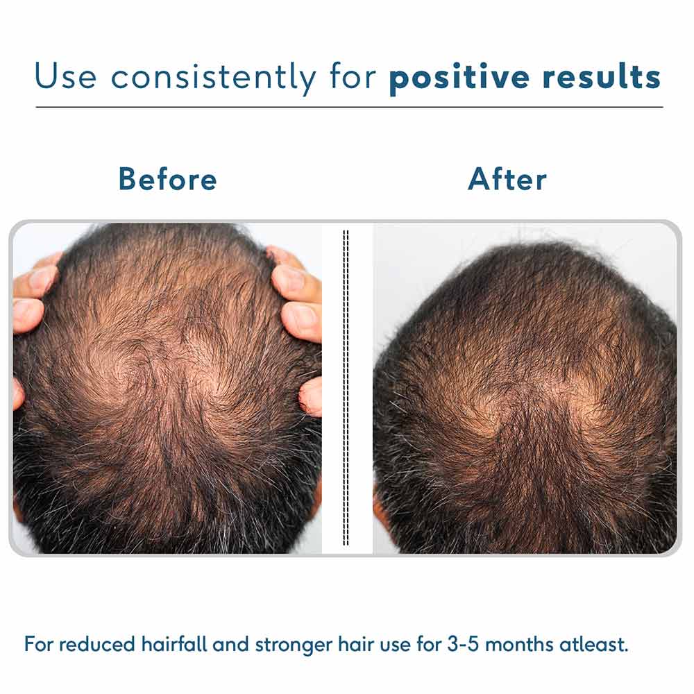 HK Vitals Hair Multivitamin & DHT Blocker 60 Tabs & Headful Growth Serum 30 ml Combo by HealthKart