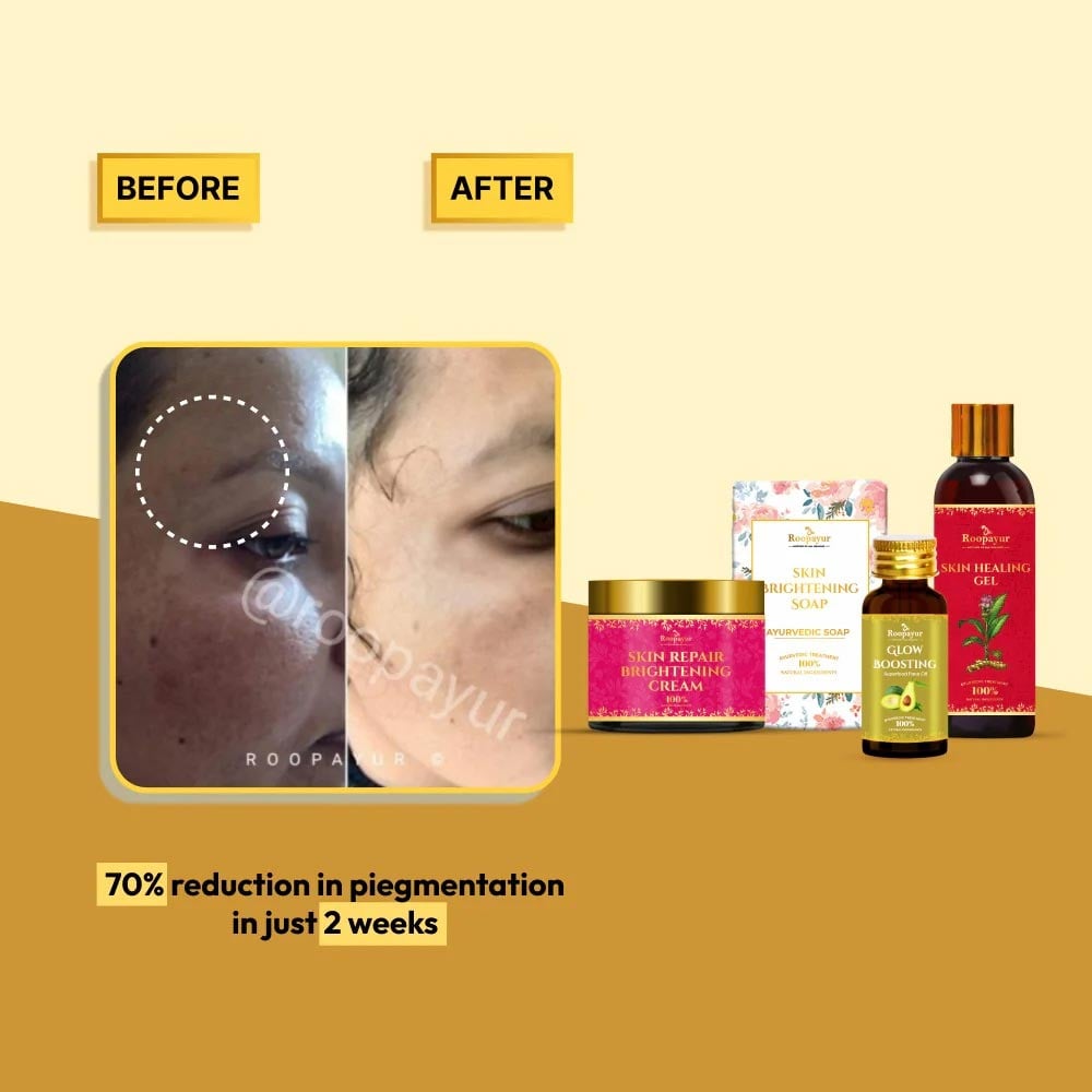 3 - Roopayur Pigmentation Care Combo,  4 Piece(s)/Pack  Skin Repair Brightening Cream + Skin Brightening Soap + Glow Boosting Serum + Skin Healing Gel 