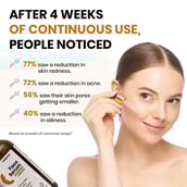 6 - myUpchar Ayurveda Face Serum, 50 ml Reduces Acne & Blemishes