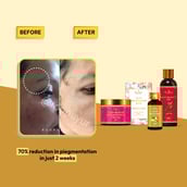 3 - Roopayur Pigmentation Care Combo, 4 Piece(s)/Pack Skin Repair Brightening Cream + Skin Brightening Soap + Glow Boosting Serum + Skin Healing Gel